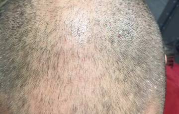 Oberkopf von Hairdreams Kunde Daniel von vorne