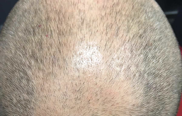 Hinterer Oberkopf von Hairdreams Kunde Daniel vor der Anwendung