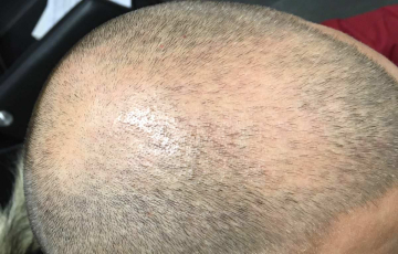 Seitlicher Oberkopf von Hairdreams Kunde Daniel vor der Anwendung