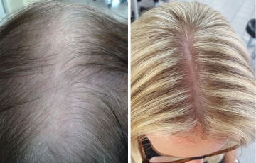 Vergleich unserer Kundin vor und nach der Stop & Grow Anwendung