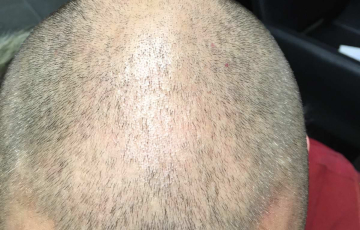 Oberkopf von Hairdreams Kunde Daniel vor der Anwendung