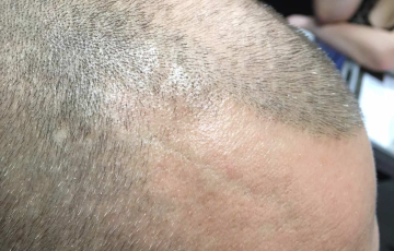 Oberkopf von Hairdreams Kunde Daniel seitlich